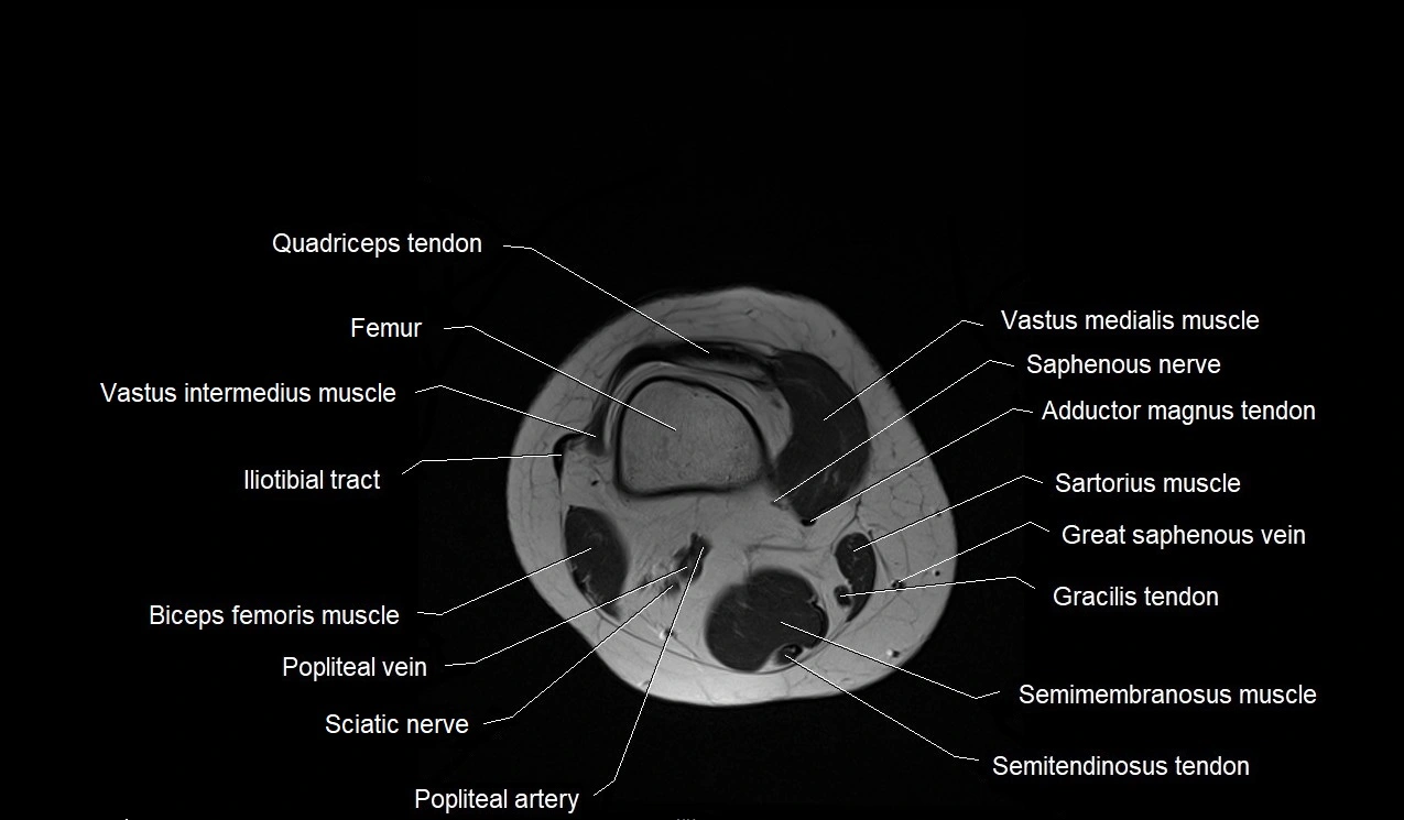 MRI thigh cross sectional anatomy image 51.webp